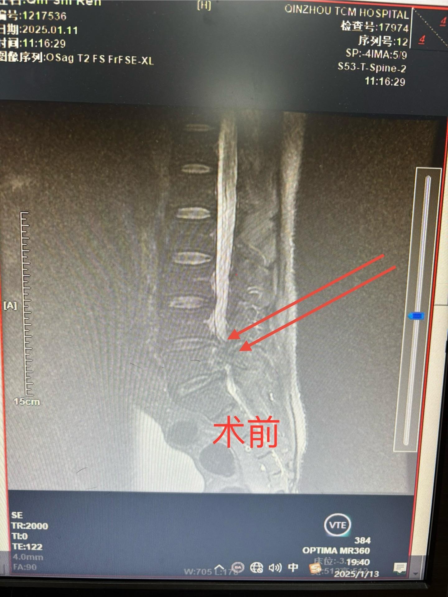 57岁男性。双下肢麻痛，无法行走，鞍区麻木，大小便失禁10天，磁共振显...