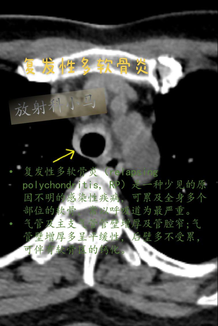 复发性多软骨炎（relapsing polychondritis, RP）是一种少见的原因不明的感染性疾病，可累及全身多个部位的软骨，常以呼吸道为最严重。病变部位包括耳、鼻、喉、支气管树及外周关节的软骨组织；为自身免疫系统疾病。发病高峰年龄在40-60岁。
特征性表现为耳和鼻软骨炎症、畸形(“菜花耳”和“鞍鼻”)。
CT影像学表现：①气管及主支气管管壁增厚及管腔窄:弥漫性增厚、光滑。②气管壁增厚多呈平缓性，后壁多不受累，可伴有软骨区的钙化。③在早期，经激素治疗，管壁增厚可部分减轻，甚至恢复正常。如未治疗，由