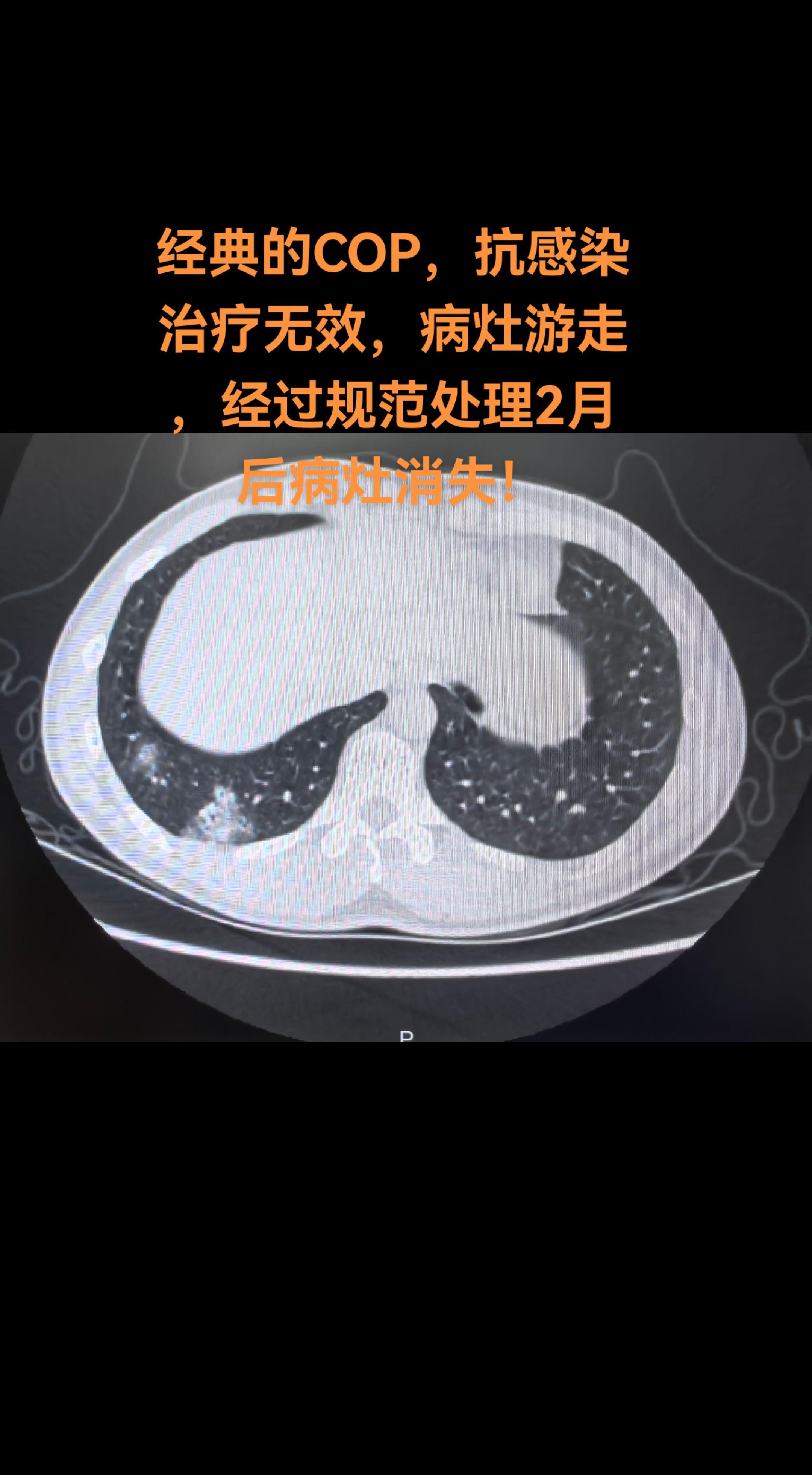 最像肺炎的“肺炎”经典COP，规范治疗后病灶消失！