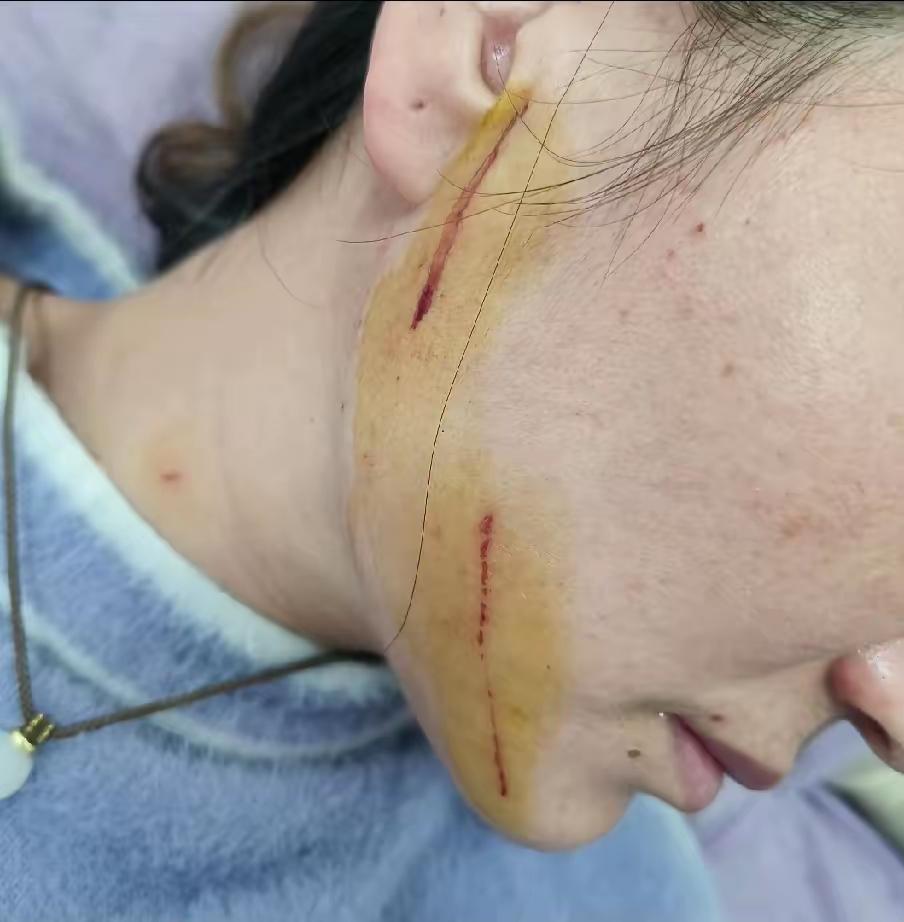 还有谁比我更惨的！婆婆给我破相了！没见过强势的女人，说啥你都要听着不能反抗，好好