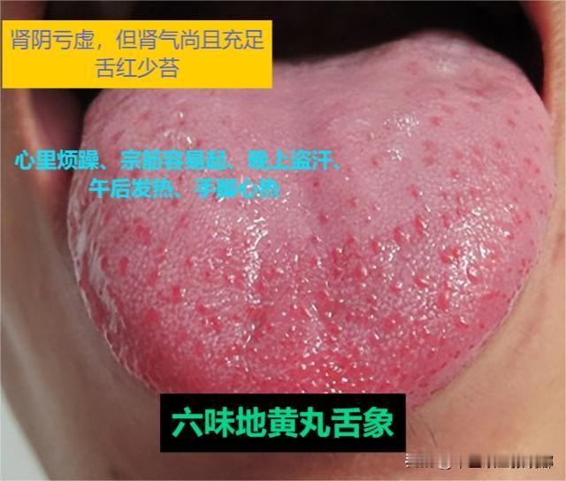 肾不好的3种典型舌象，用哪种地黄丸去调理？中医一次性教给你

1、六味地黄丸。
