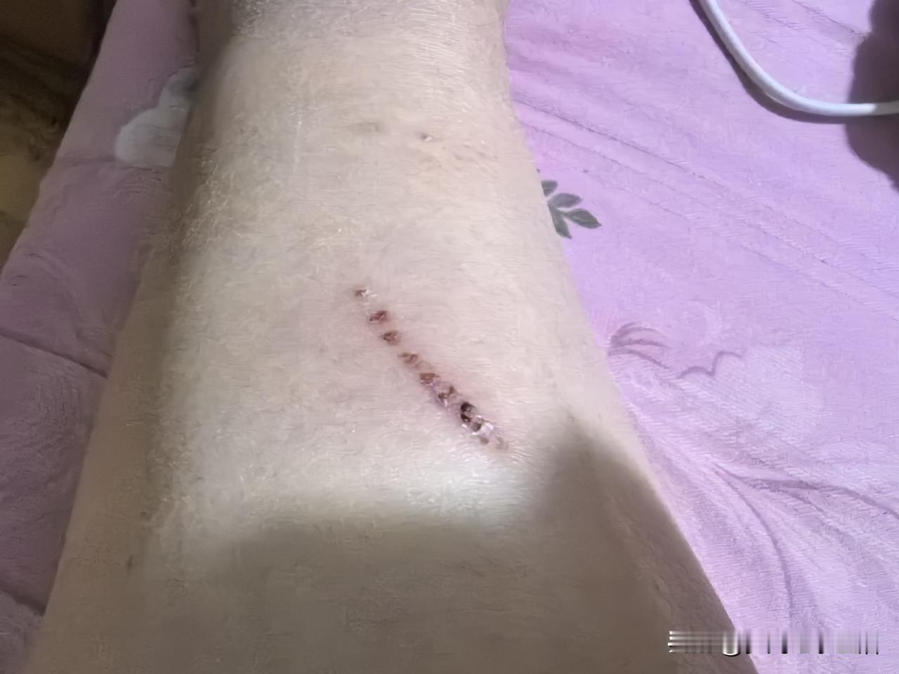 昨天晚上，我看自己那天去野地里采茶叶被划伤的小腿已经全部结痂了。挣的63块钱早就