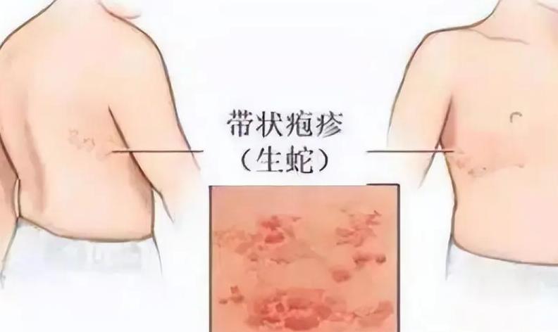 大四女生吃甲钴胺片治带状疱疹，半年后体检结果令医生意外

一位大四女生患上带状疱