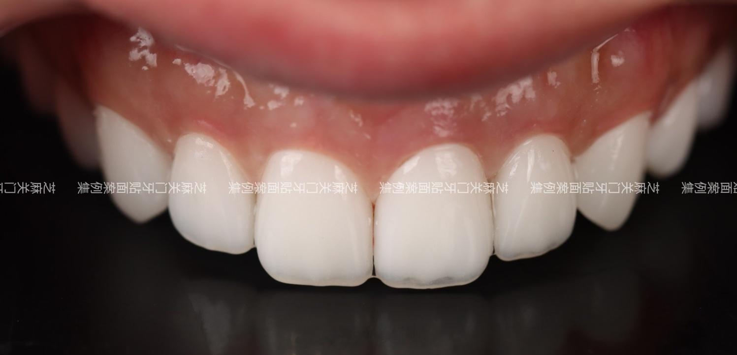 杭州牙贴面团真实野生反馈群友宝宝是去年三月在我这参加了牙贴面团做完以后改善非常大