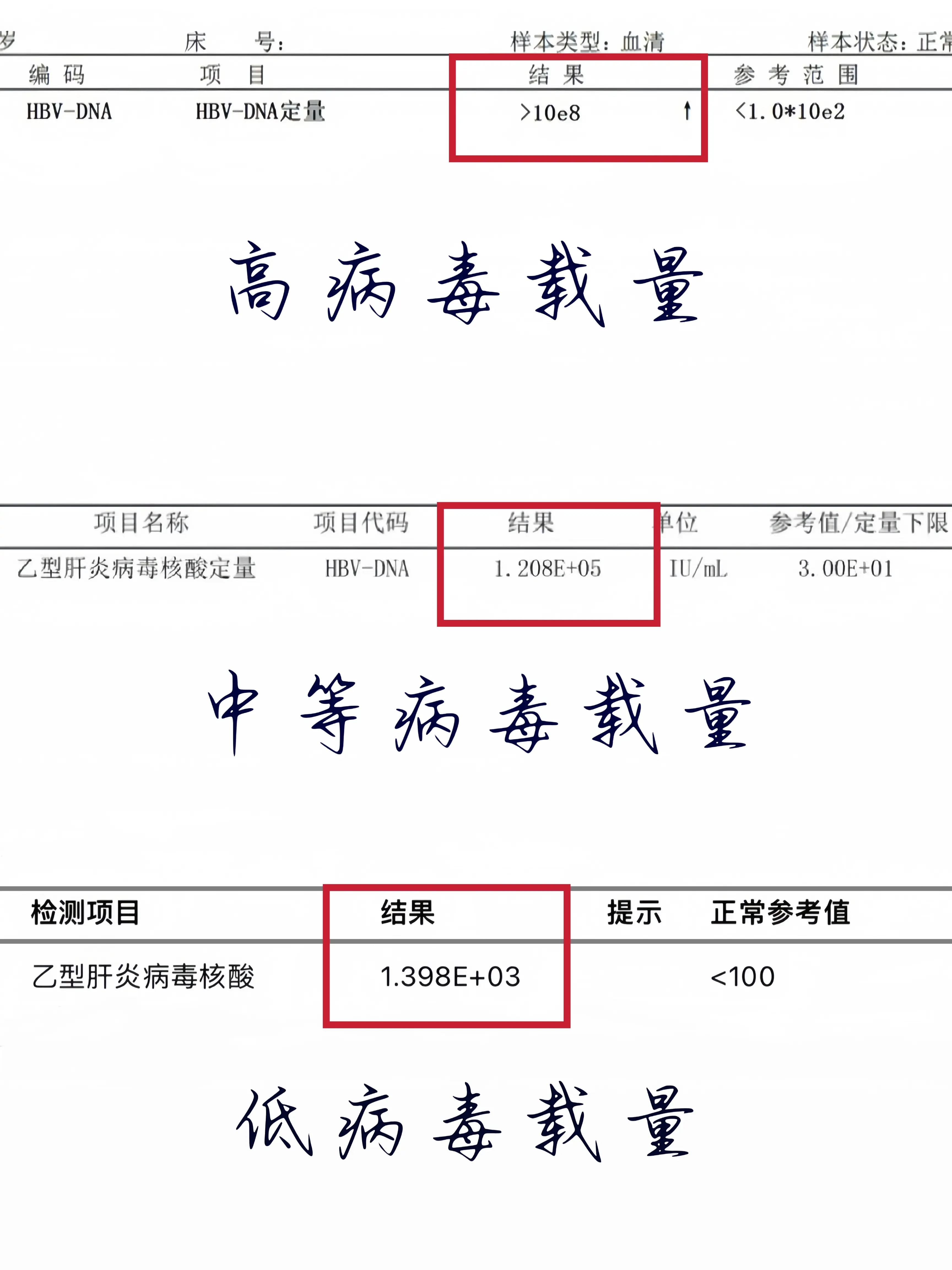 乙肝病毒量多少正常？ ①高病毒载量：大于10的6次方，这意味着血液中的...