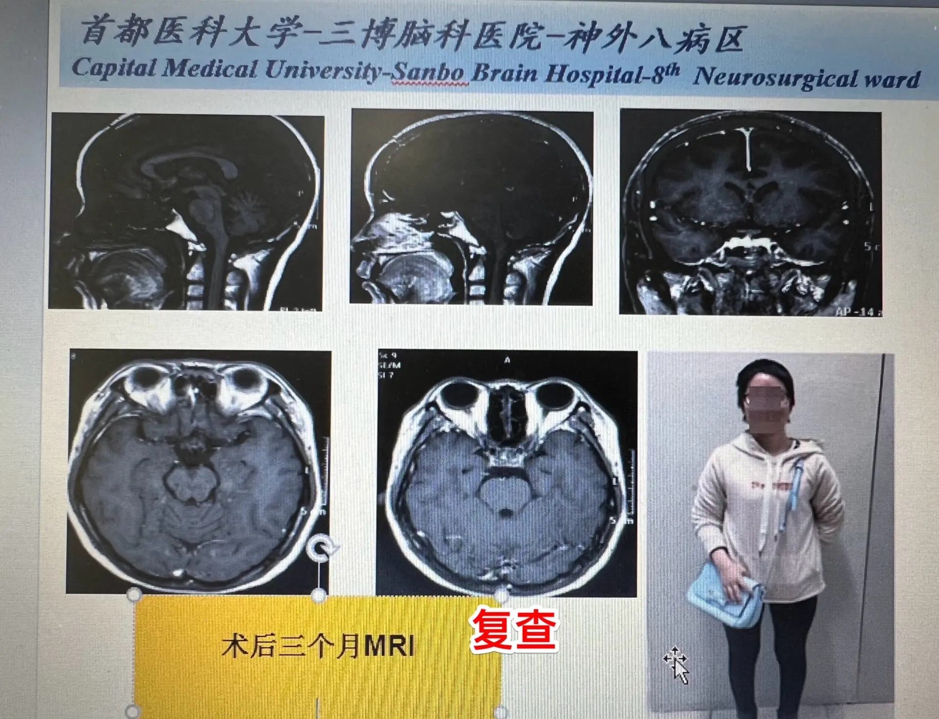 病友报喜，baby降生了，母子平安！武汉的女性病友因头痛在2018年5...