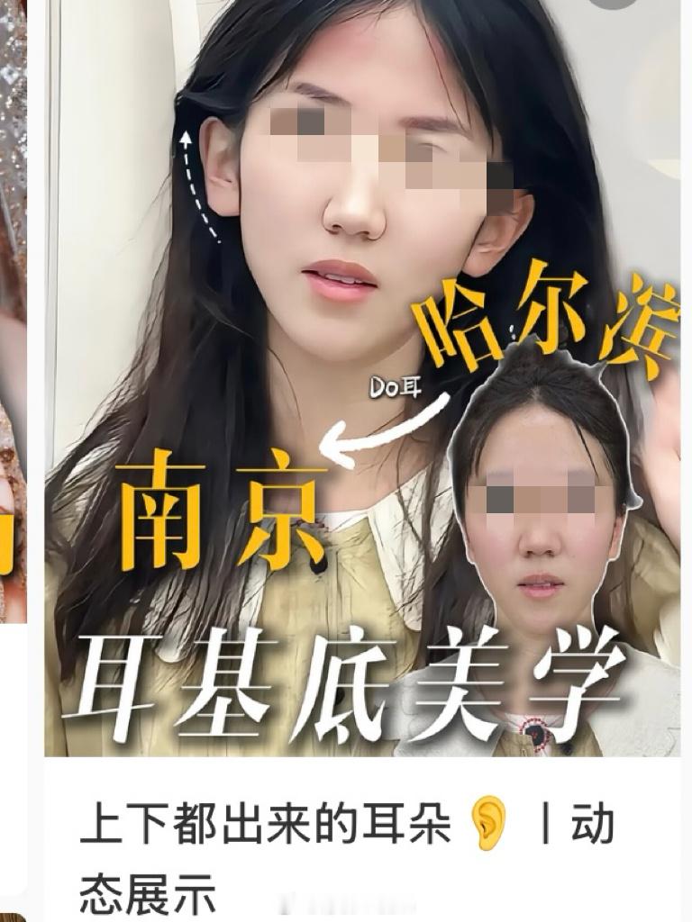LV锚定耳基底提升？能不出来害人了吗‼️我发现医美圈真的很会炒冷饭，把一个800