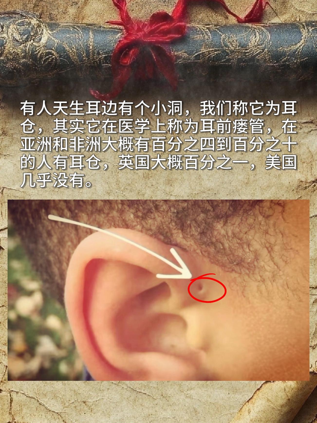 有人天生耳边有个小洞，我们称它为耳仓，其实它在医学上称为耳前接管，在亚...
