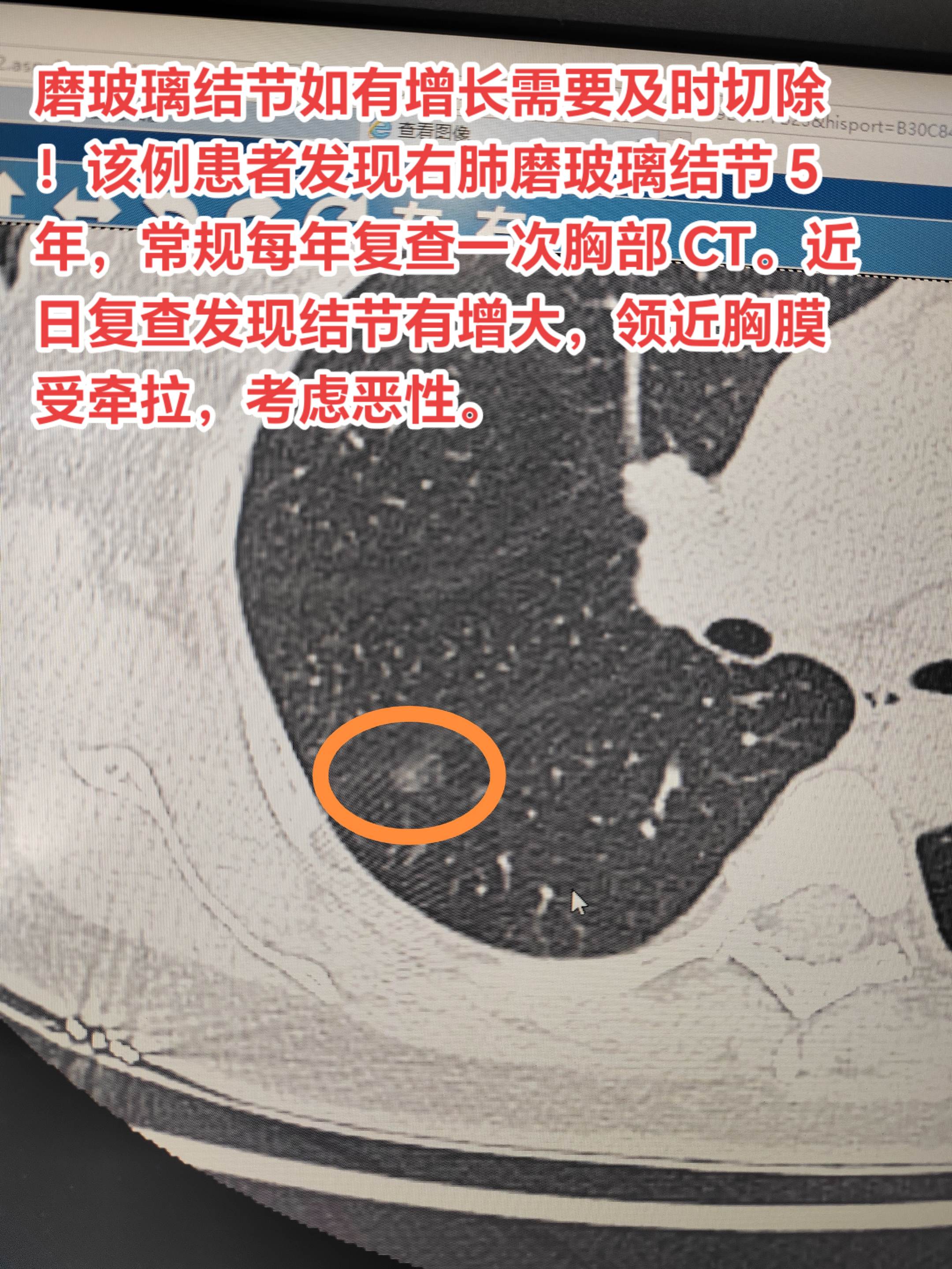 磨玻璃结节如有增长也需要及时切除！该例患者发现右肺磨玻璃结节 5 年...