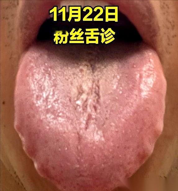 伸出舌头我瞅瞅。
要是舌头中间有深深的裂纹，两边还一圈整整齐齐的牙印子……
得，