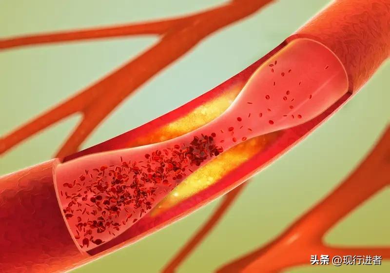 深夜强撑的危害远超想象！医学专家发出紧急警示：当连续72小时睡眠不足4小时，心脏