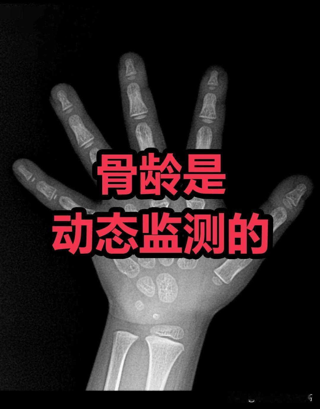 测骨龄是智商税？你压根儿不清楚监测骨龄的底层逻辑是什么
监测骨龄本身是一个动态的