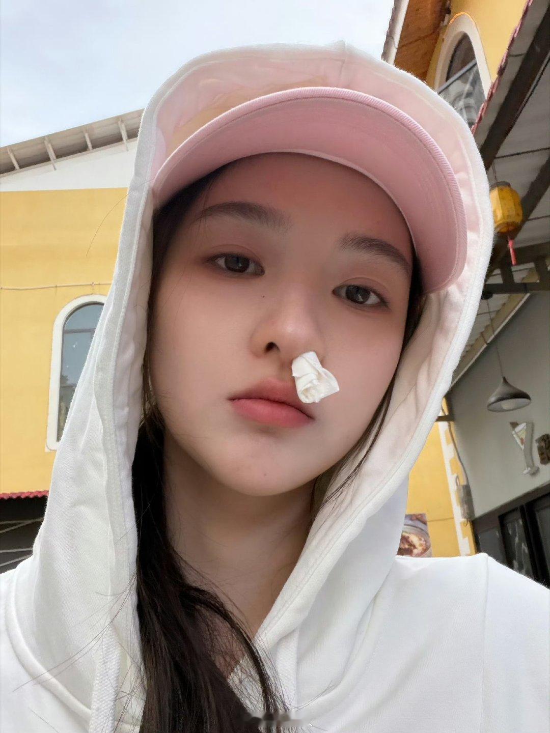 王玉雯急性鼻窦炎早日康复啊姐姐 