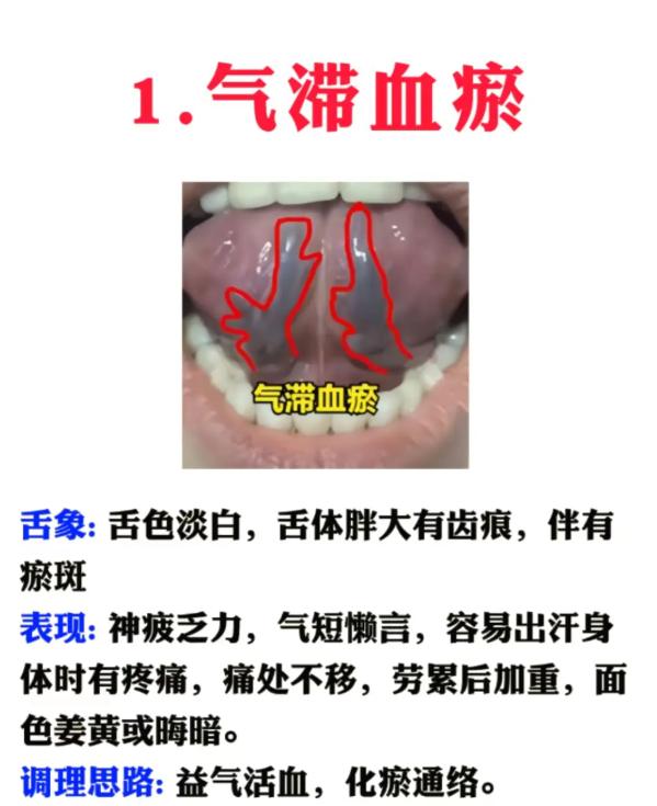 血瘀并非只有一种！5 种分型舌象对照，看看你是哪一种