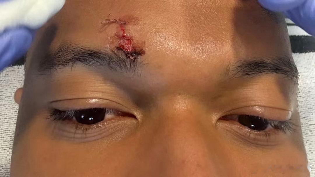 阿斯：姆巴佩眉骨缝三针，缺席训练但将配备防护措施出战拜仁据《阿斯报》报道，上轮西