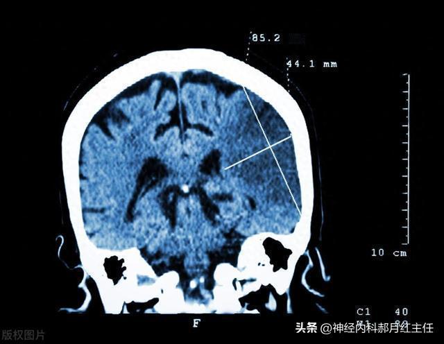 脑梗了，还能彻底恢复吗？
 
脑梗后遗症难康复是众所周知的，脑梗后遗症能否恢复，