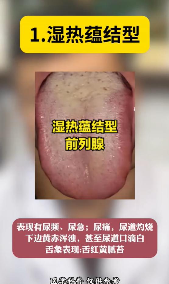 从舌象看前列腺问题的 5 种中医分型