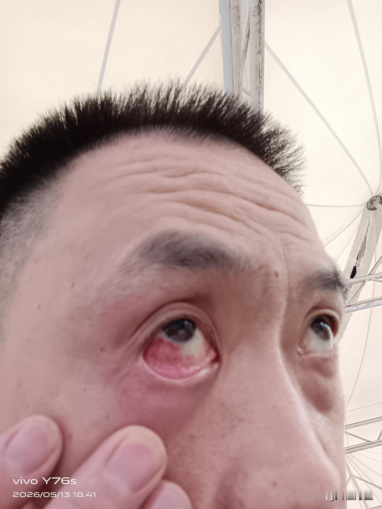 这一只眼红了半边，什么病？