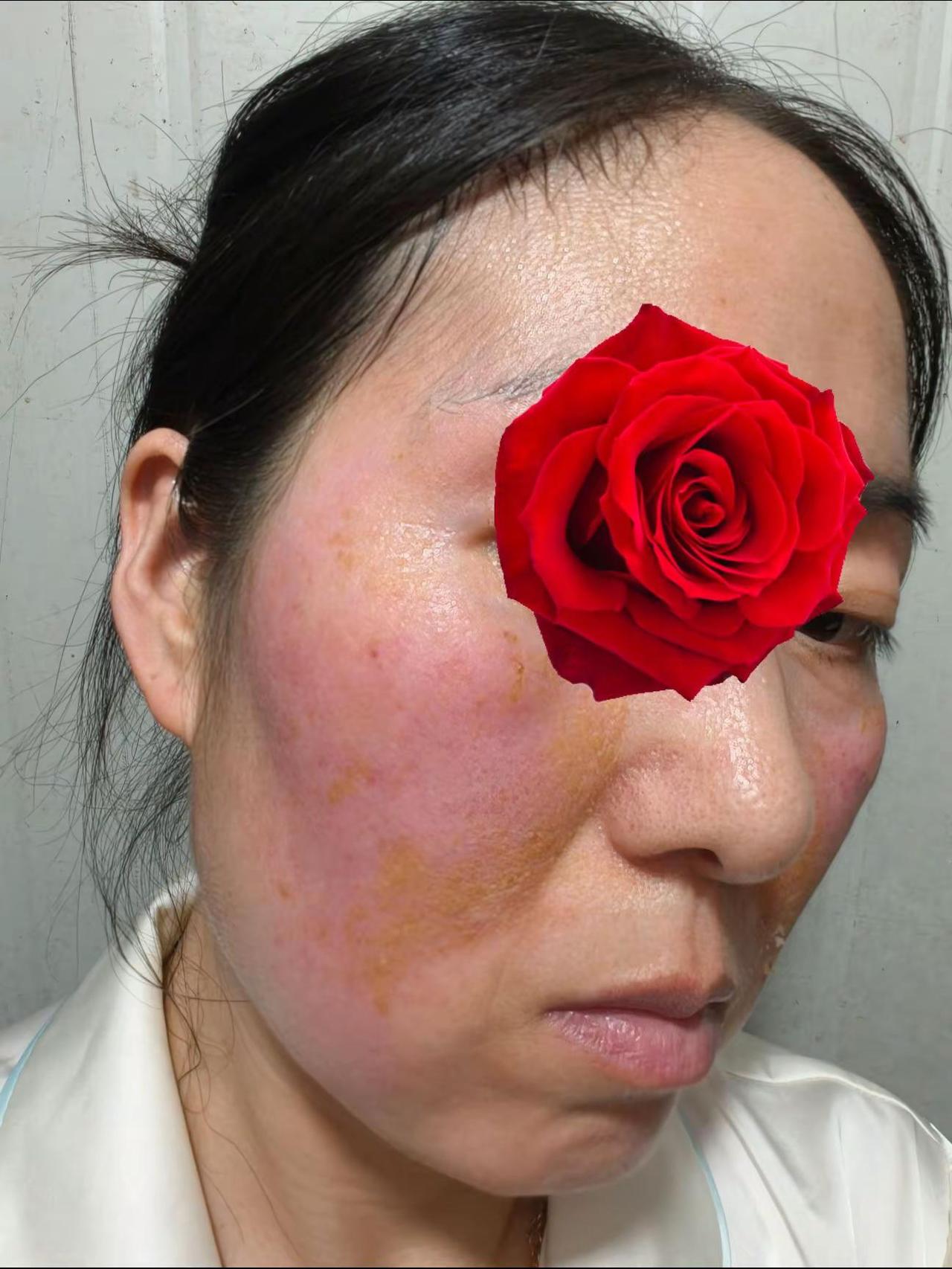 玫瑰脸一天一天的状态