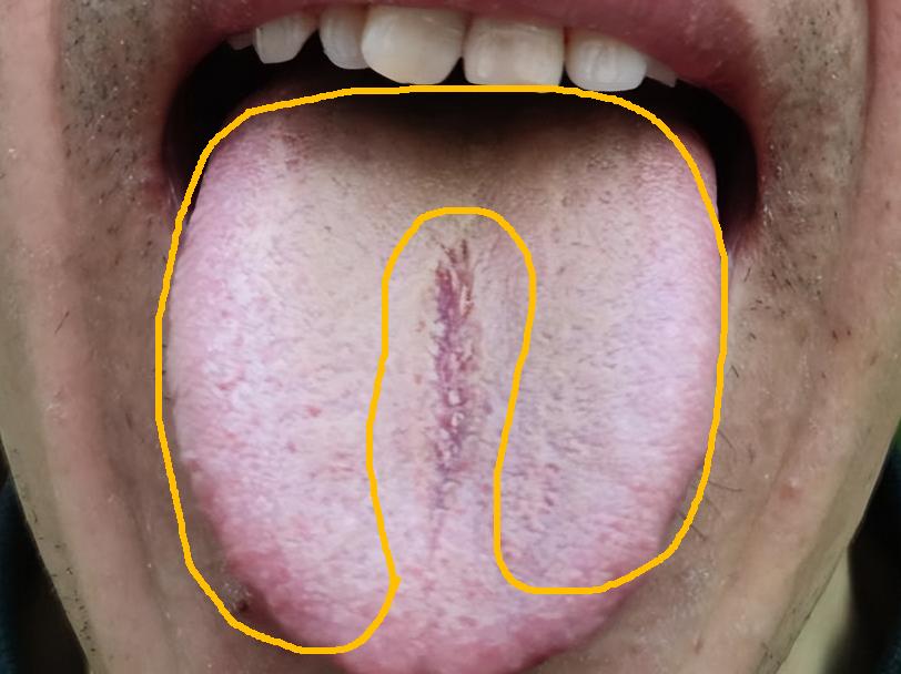 男人不怕肾虚，就怕肝郁化火，你还在等啥呢？
这种舌象再拖的话，调理恐怕，要费一年