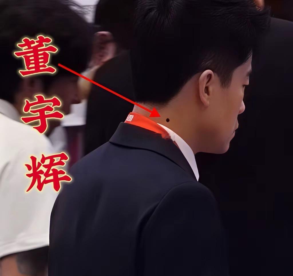 董宇辉参加海南消博会，很多镜头追踪拍摄，有人拍到他脖子侧后边的大瘊子，还是挺明显