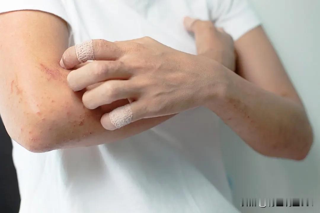 反复瘙痒起疹？5个经典中成药调理慢性湿疹，温和祛湿不刺激，一文读懂
 
慢性湿疹