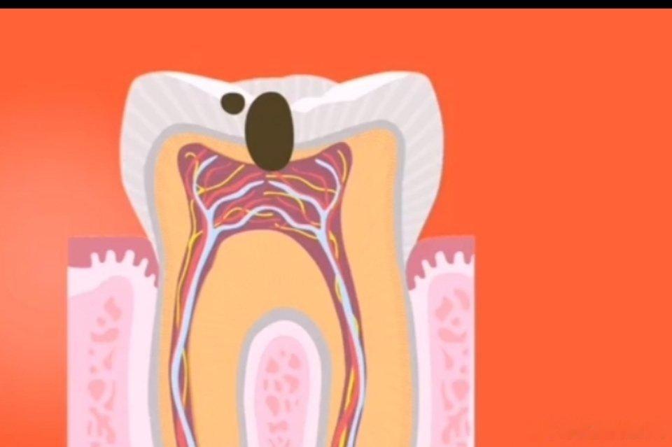 ​老年人有什么好的护齿方法？　　保护牙齿的方法1.正确刷牙。　　“预防牙龈感染的