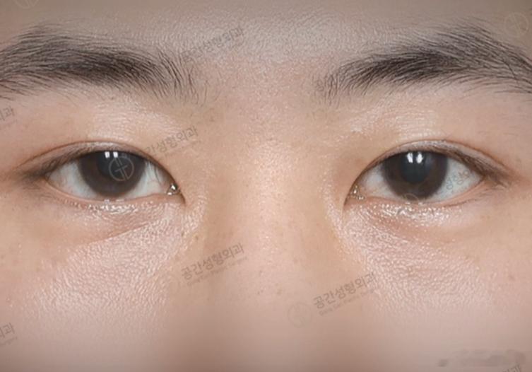韩国专门做男生眼睛的，切开+提肌的2组案例 