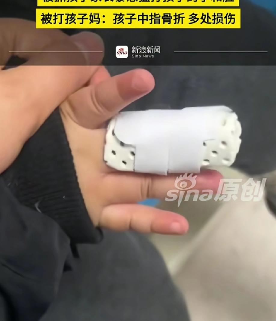 这就是狂的代价！两个孩子闹矛盾，家长竟然直接把另一个孩子的手指打骨折，怎能不让人