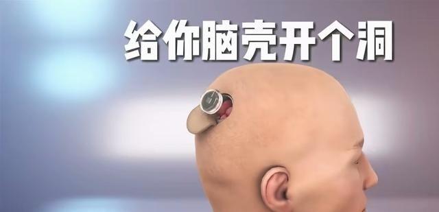 有钱我也想装脑机接口，但别指望变超人，那玩意儿现在主要是给瘫痪病人用的，想靠它下