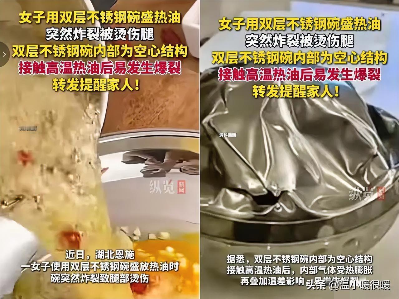 🔥 血淋淋的教训！湖北恩施一女子做饭时想图个方便，用双层不锈钢碗盛刚烧好的热油
