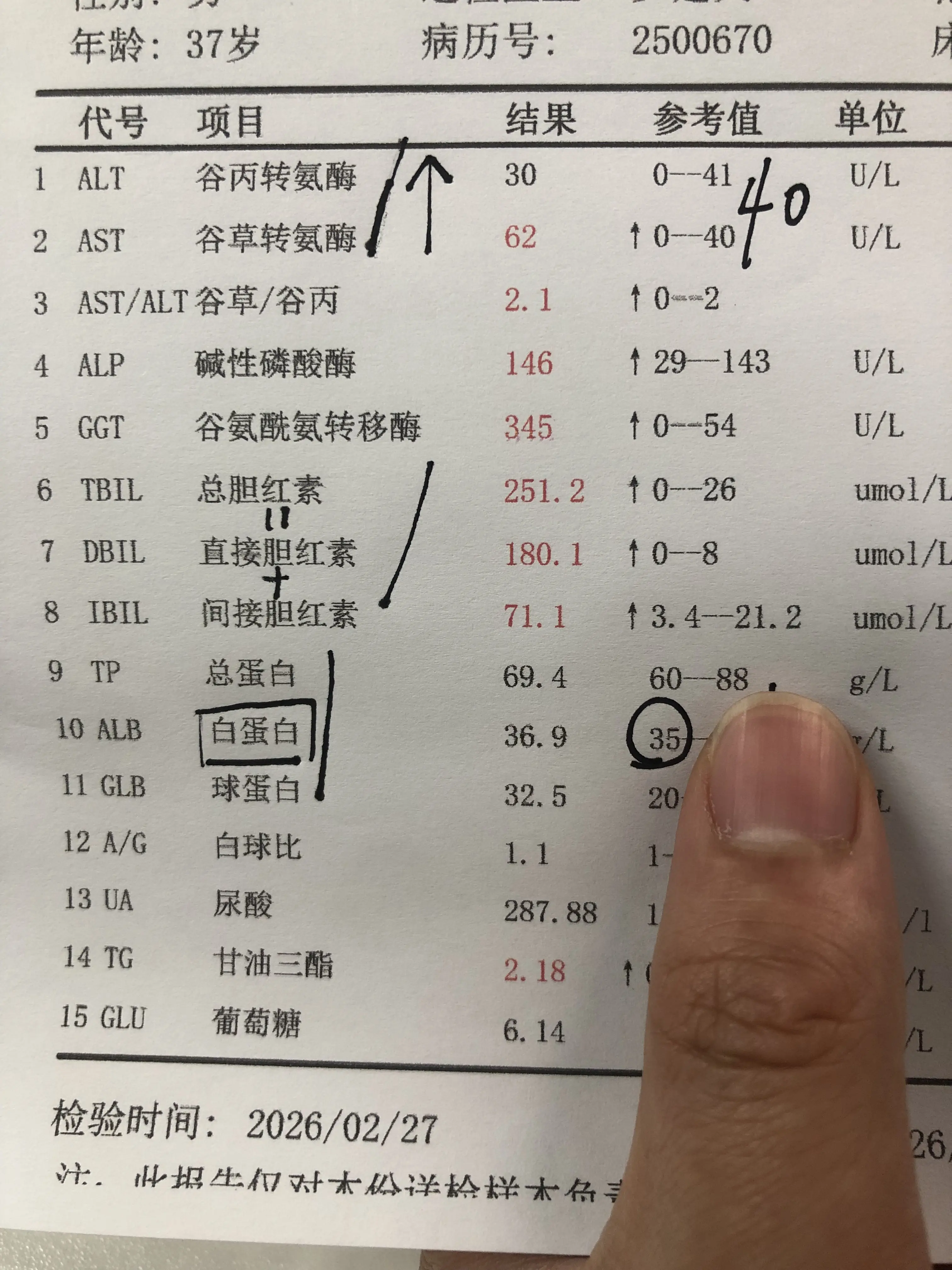 转氨酶不高啊，怎么就肝硬化了？ 以前他总以为，只有转氨酶升高才会伤肝...