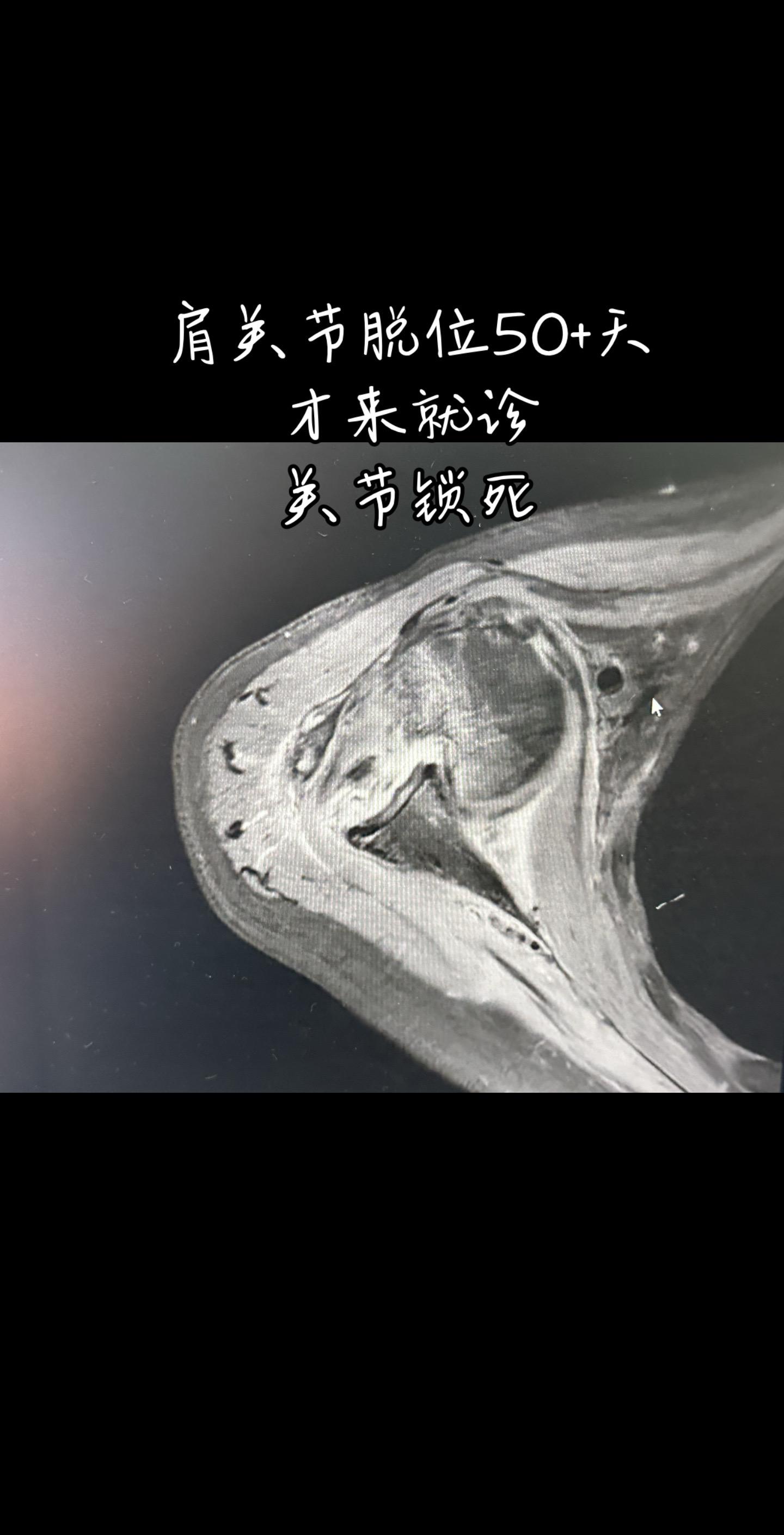肩关节脱位50多天才来就诊。肩关节脱位五十多天 关节锁死了