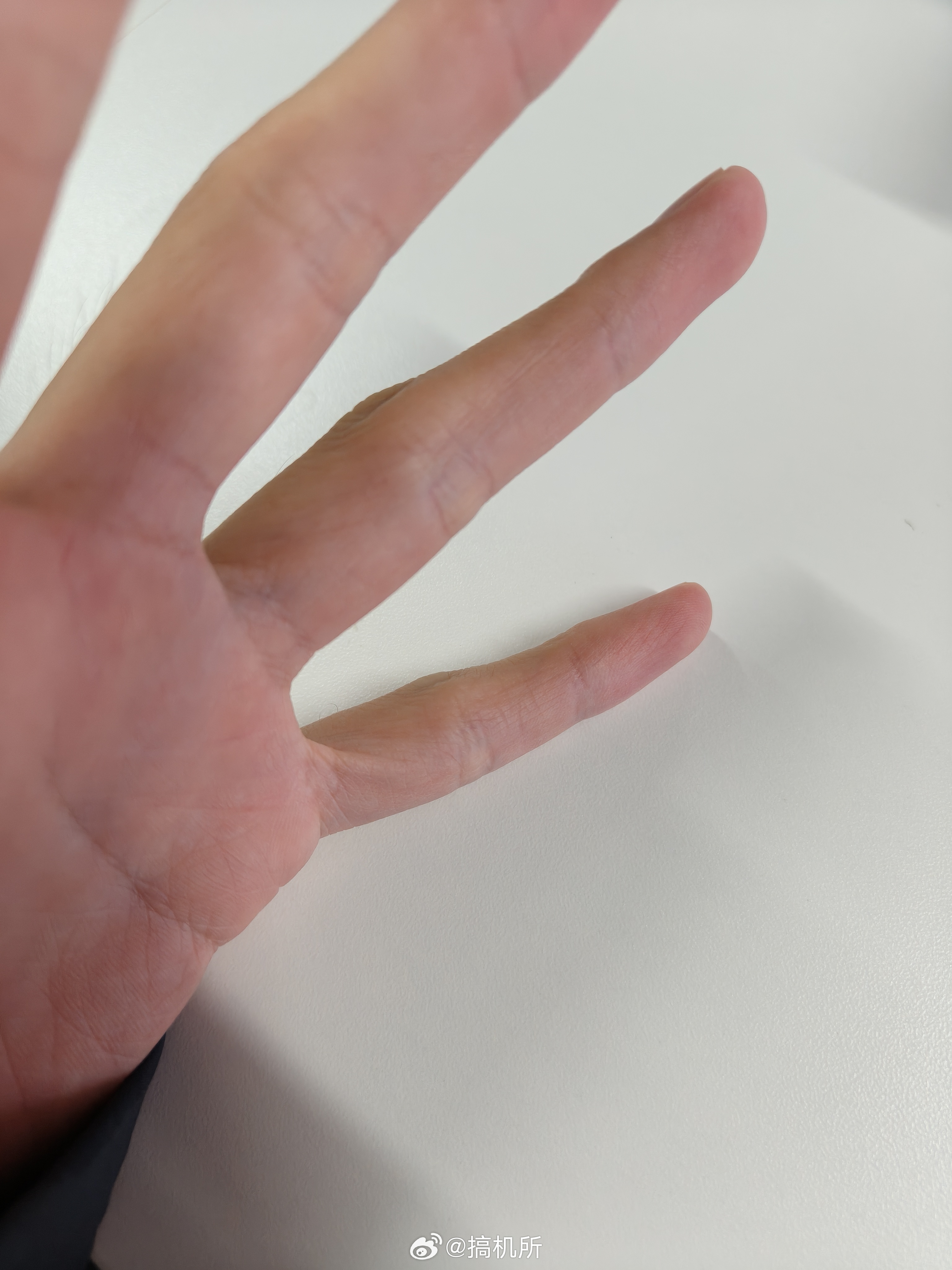 长期用小拇指托手机的后果之前了解到用小拇指托手机容易导致小拇指变形后，我就开始改