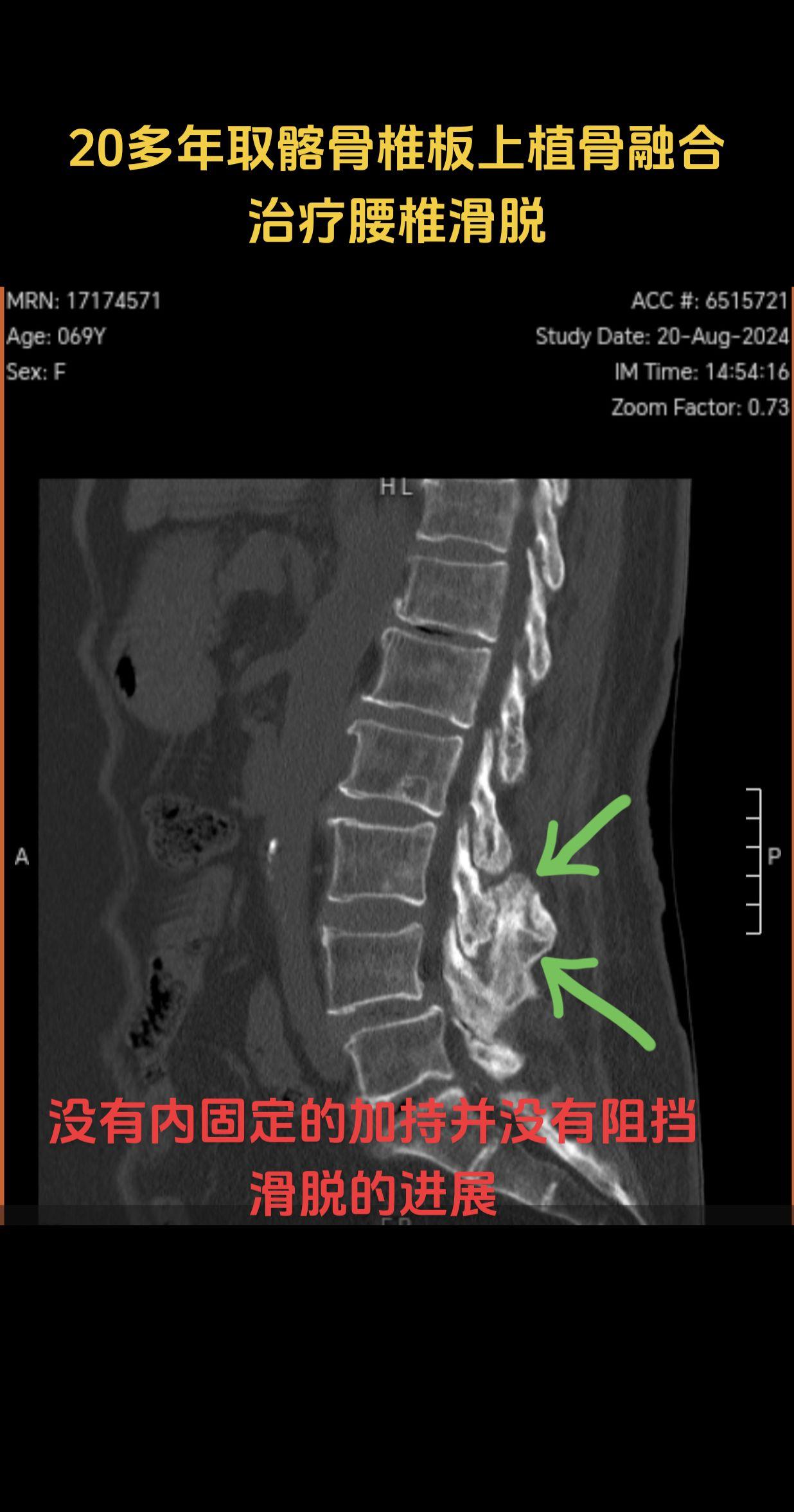 腰椎滑脱翻修。事实证明没有力学上的稳定（不打螺钉）的手术技术，经不起时...