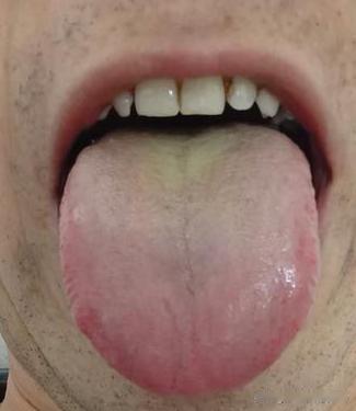 湿热越重，肾越虚！中医教你1招，健脾肾、祛湿热，让你重振旗鼓
这位粉丝大约三十多