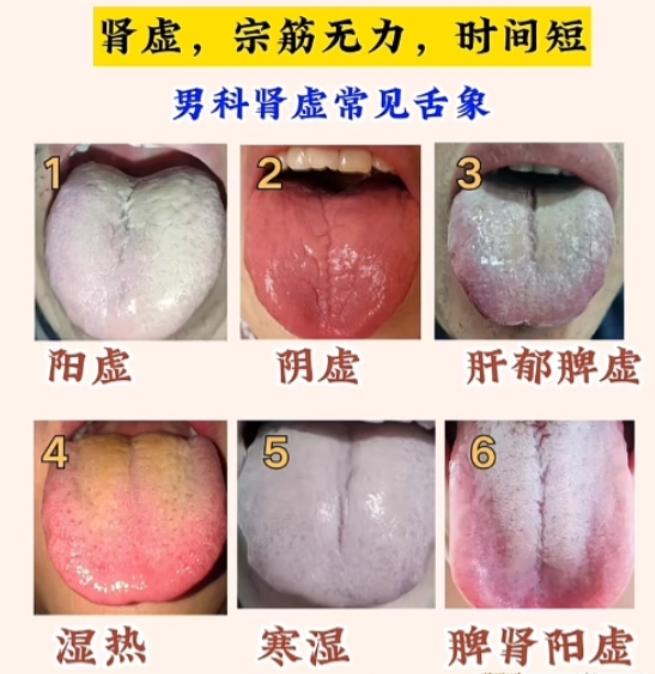 男人肾好不好，看舌头就清楚！
应粉丝要求，专门抽时间分析男科舌诊！

下面六种你