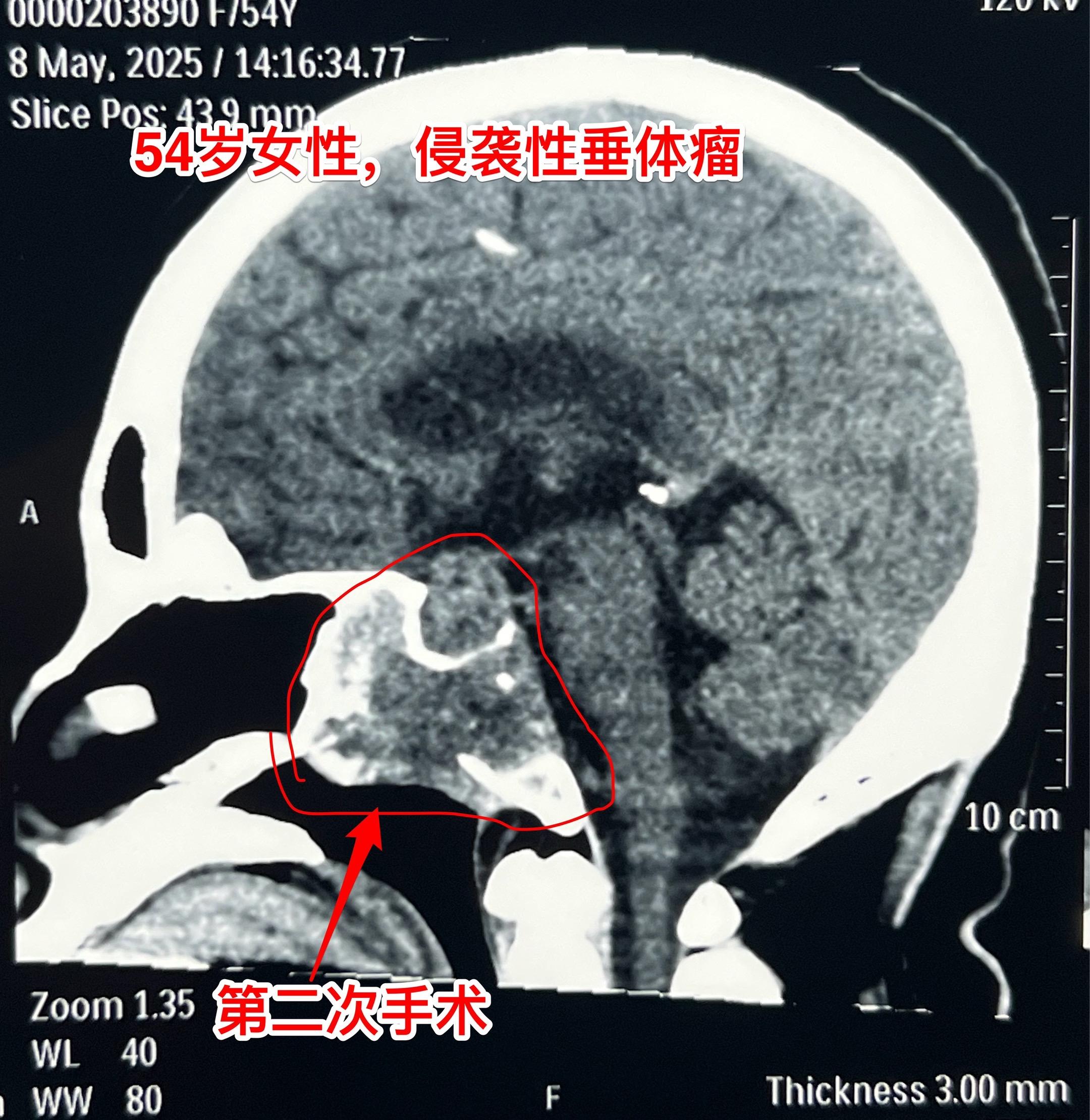 侵袭性垂体瘤第二次手术。54岁女性，2023年9月因垂体瘤作了第一次手...