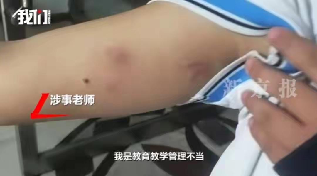 孩子的胳膊被老师掐出血痕；疑似未参加老师补课班，四人受伤，双方各执一词。
12 