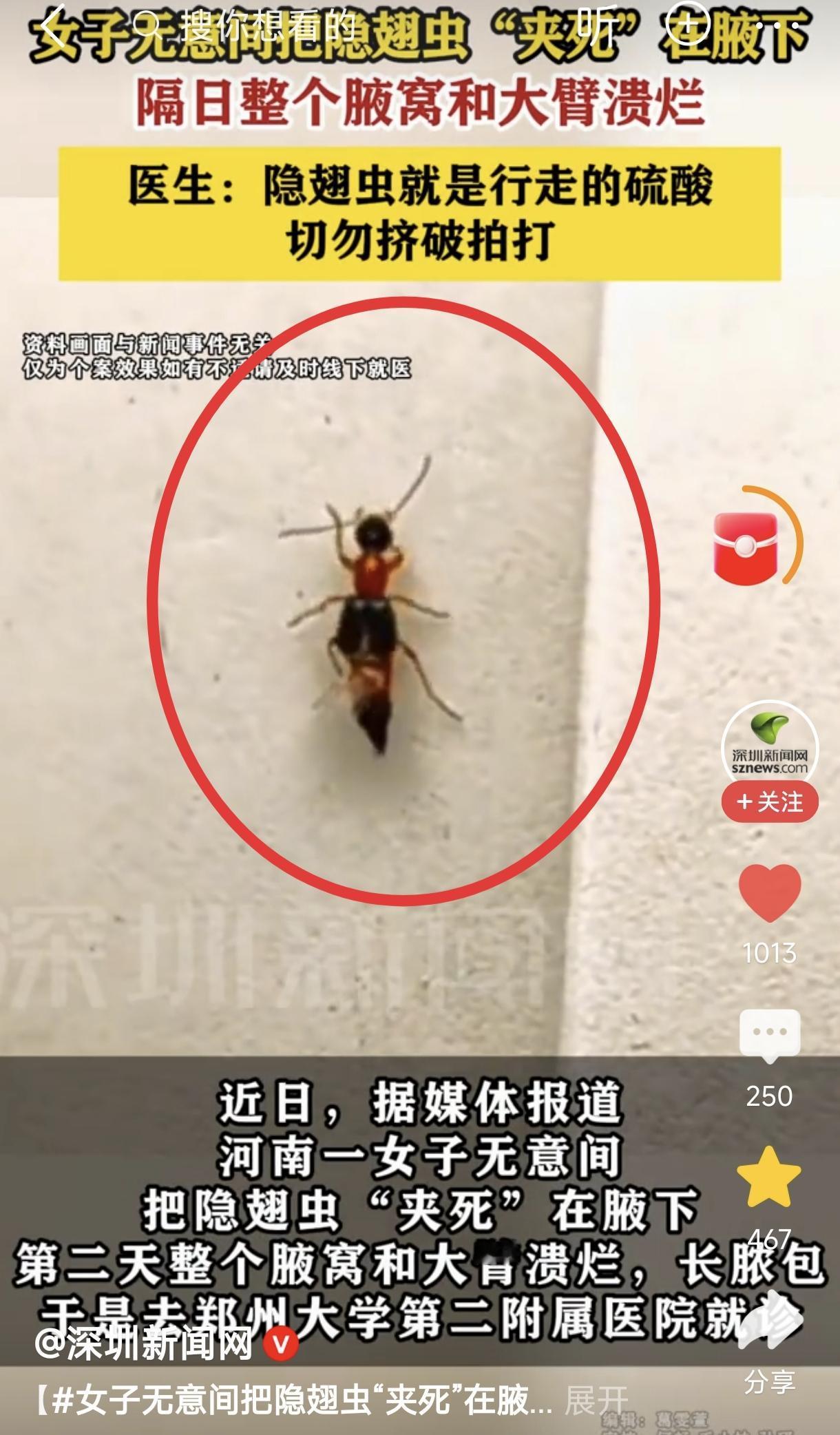 “太可怕了！”河南，一名女子无意间将一只隐翅虫“夹死”在腋窝，当时完全没放在心上