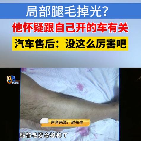 浙江诸暨，男子开新能源车1年，突然发现自己两条腿上原本茂密的毛发，竟然都掉秃了，