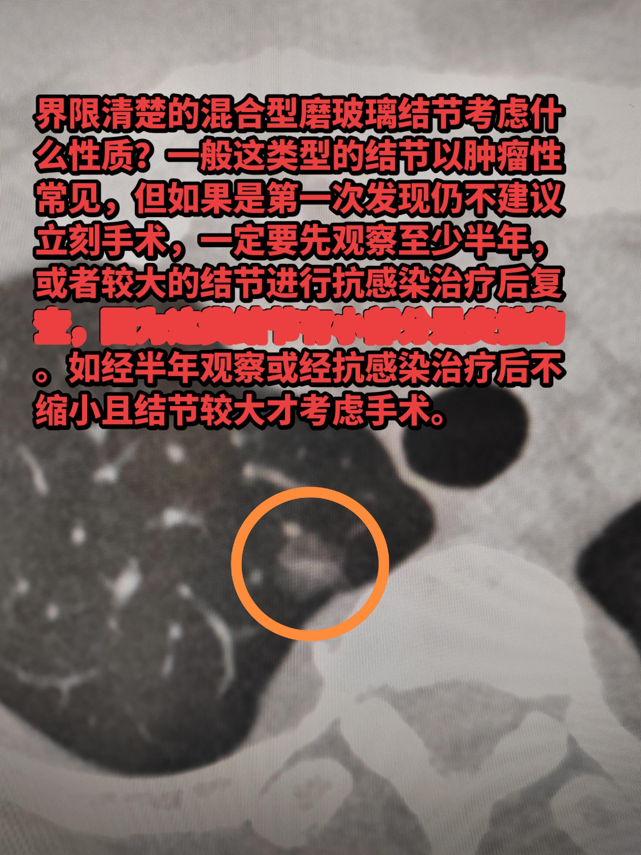 混合型磨玻璃结节界限清楚好吗？界限清楚的混合型磨玻璃结节考虑什么性质？...