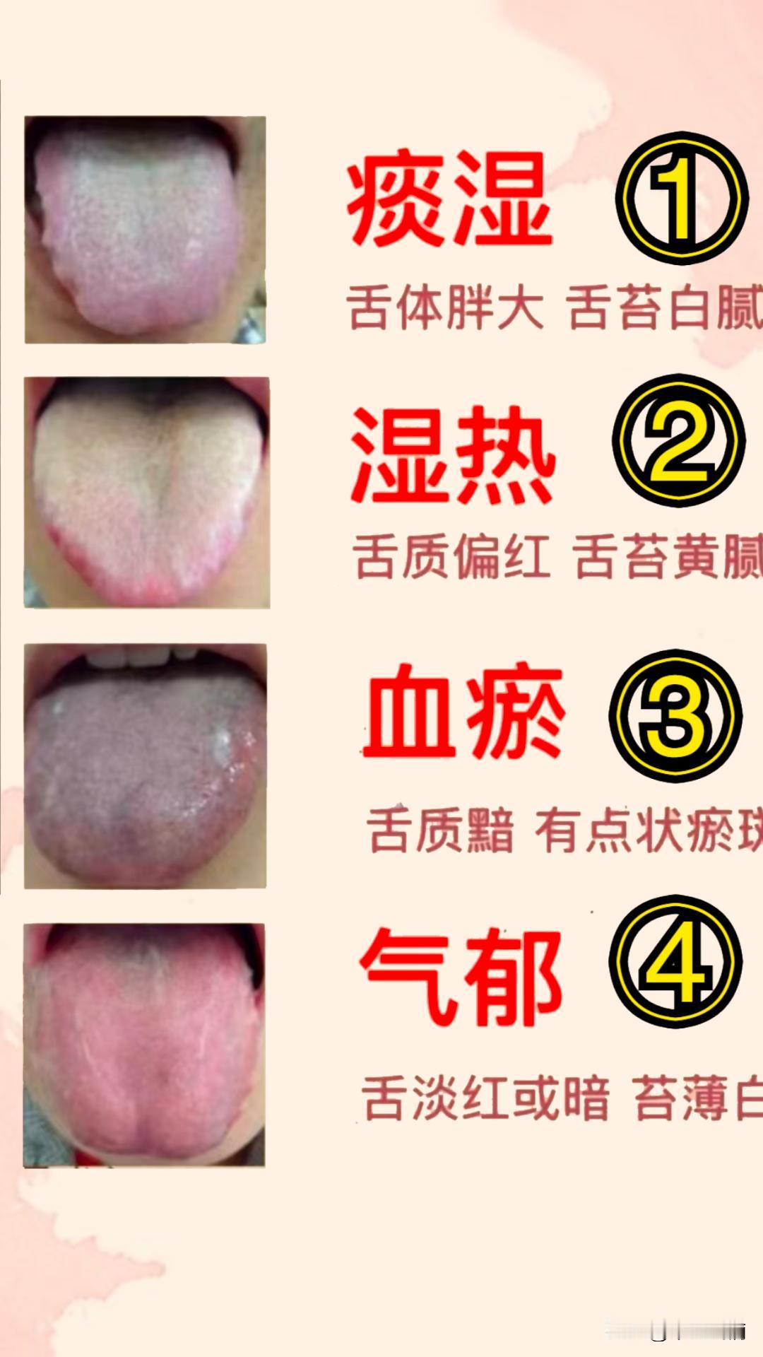 舌象分析，免费看诊，你是哪种情况？

1、痰湿

2、湿热

3、血瘀

4、气