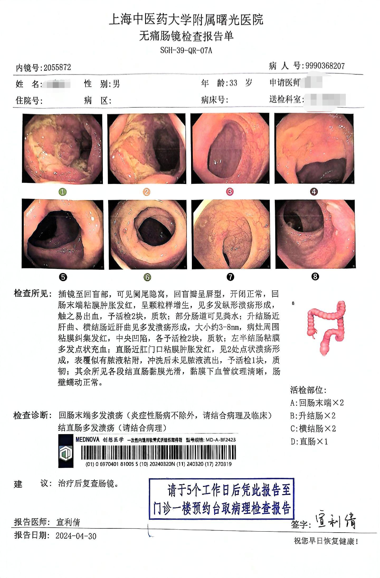 这就是克罗恩病肠镜的典型表现。1.小肠末端多发的纵行溃疡。2.右半结肠比左半结肠严重。3.病变呈现跳跃性的病变。4.小伙子做不下来屁股上有个硬块，其实就是肛周脓肿。5.crp，血沉，血小板明显升高，排除急性感染后肯定还是高的。