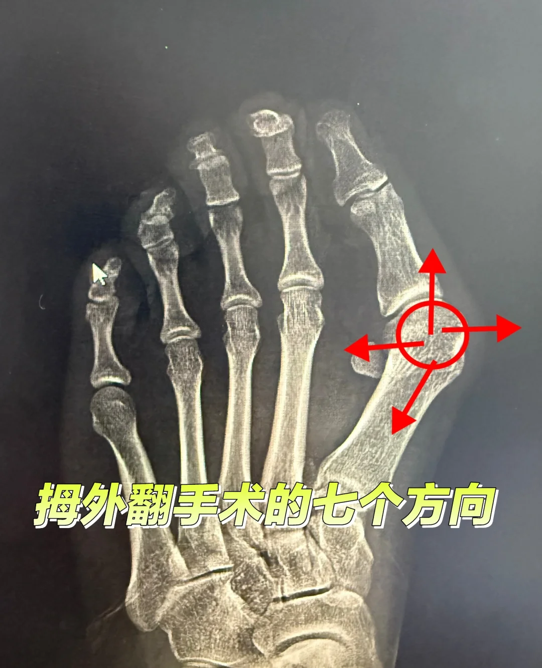 拇外翻手术的七个方向
