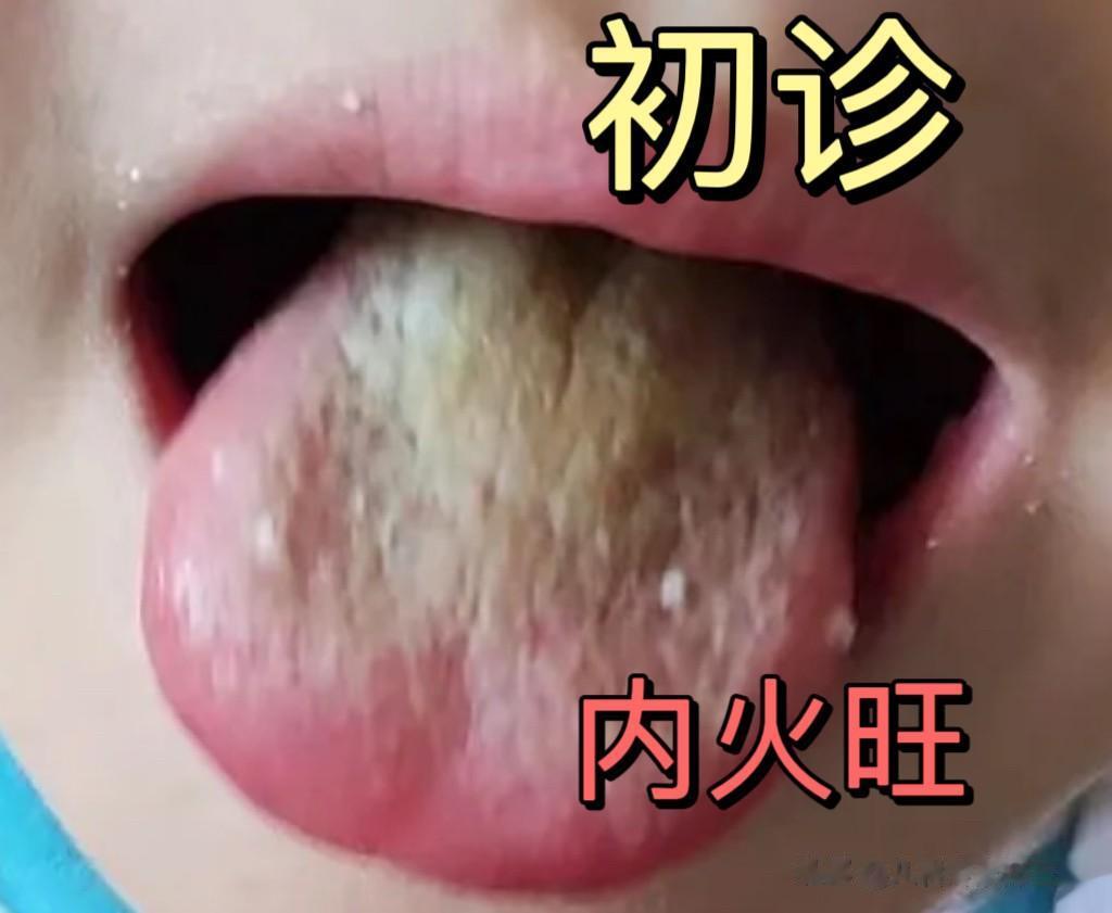 积食、便秘、偏食挑食、胃口差、草莓舌、舌苔白厚、地图舌、不长个不长肉、趴睡、睡觉