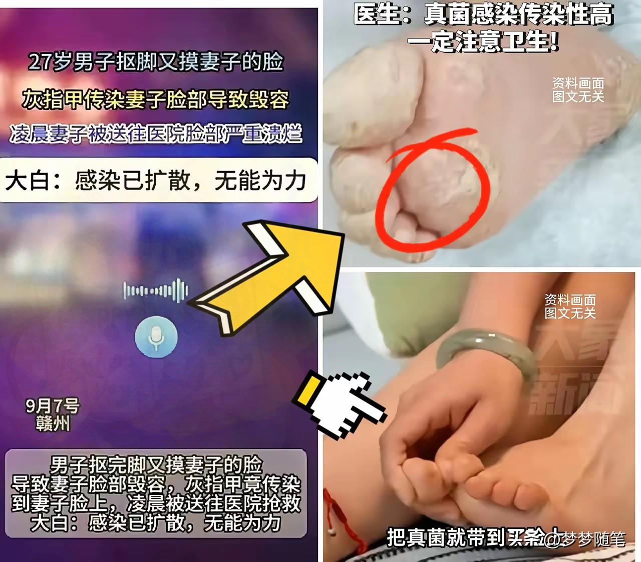 真的太可怕！
27岁男子不讲卫生，用扣过脚的手去摸妻子的脸，由于男子有灰指甲，