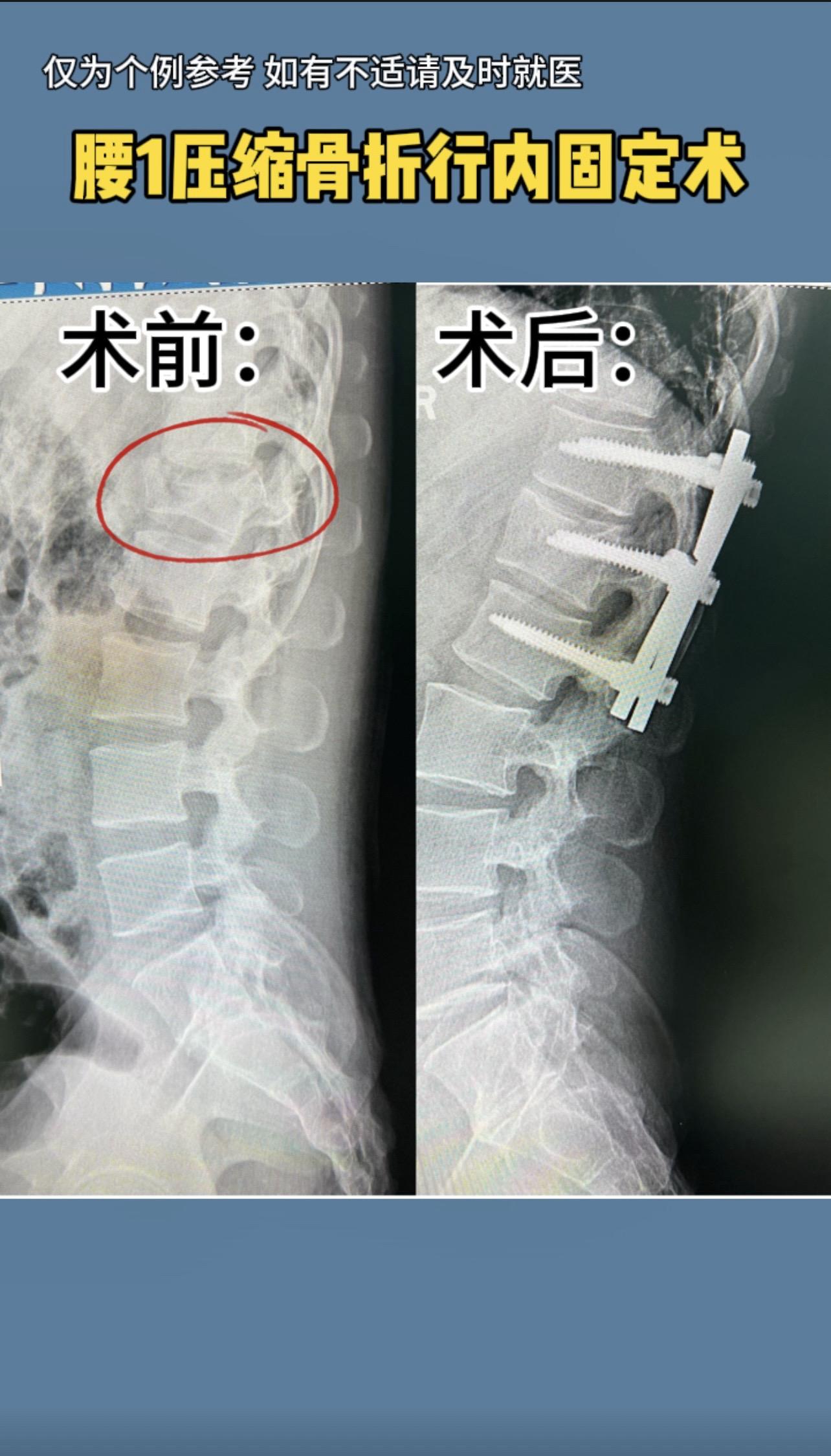 30多岁男性，腰1压缩骨折行内固定术后2年半，椎体高度基本恢复，腰椎曲度也基本恢复正常。
刚哥提醒：对于压缩程度超过1/2的年轻患者的椎体骨折，还是建议内固定手📖治疗。