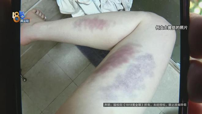 【女生被教练帮肌肉松解后腿部淤青 一年了还没褪？】瑜伽馆回应女生被教练肌肉松解腿