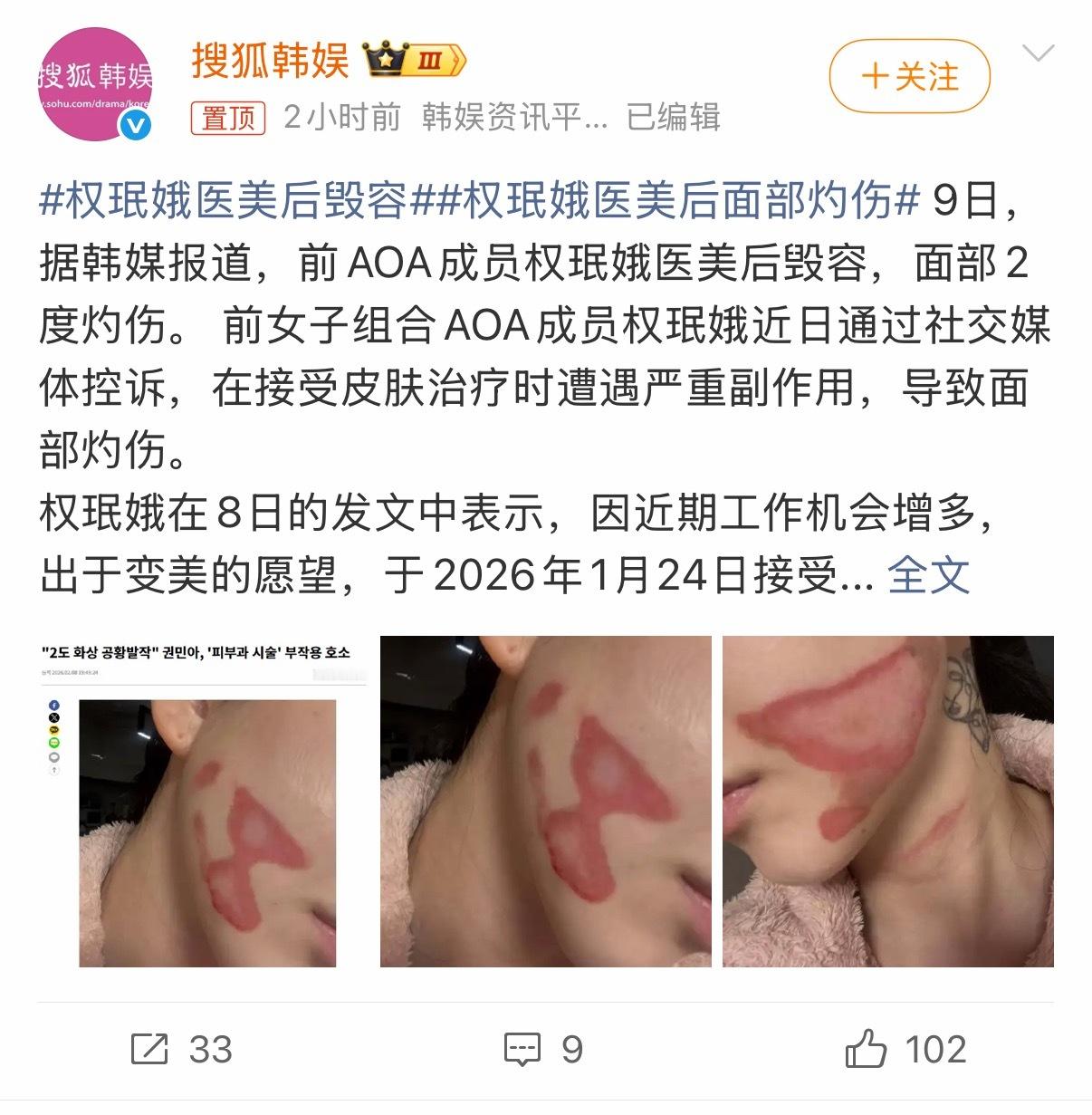 天呢，这种疤痕对于一个普通女生来说天都塌了，更何况是艺人，这还不是侵入式的医美，